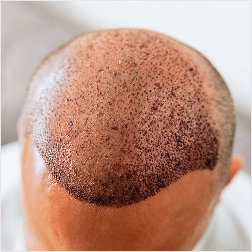 Hair Transplant Turkey