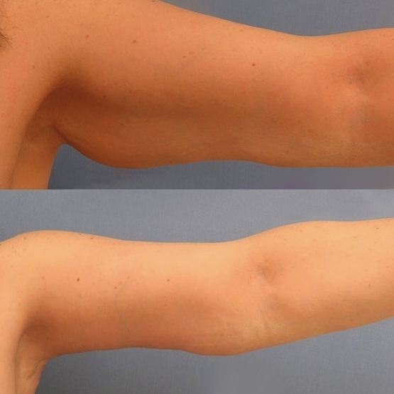 Arm Lift in Turkey Before and After