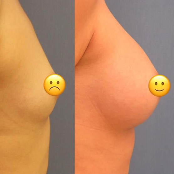Breast Augmentation Turkey Before and After