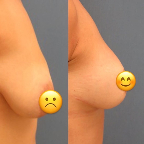 Breast Lift in Turkey Before and After