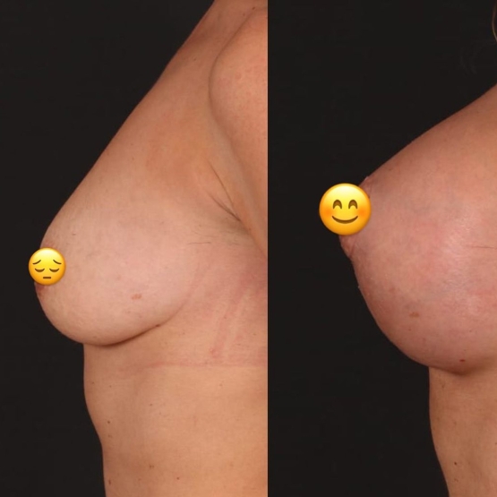 Breast Lift in Turkey Before and After
