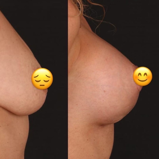 Breast Lift in Turkey Before and After
