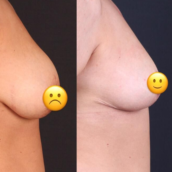 Breast Lift in Turkey Before and After