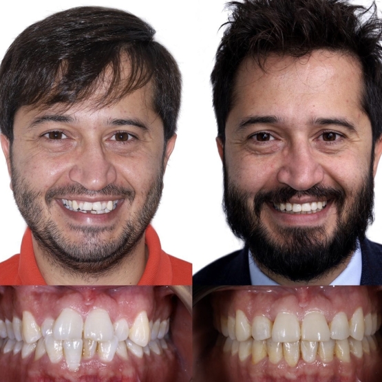 The treatment of our patient, with severe crowding was completed with clear aligners in 1.5 years (25 + 14).