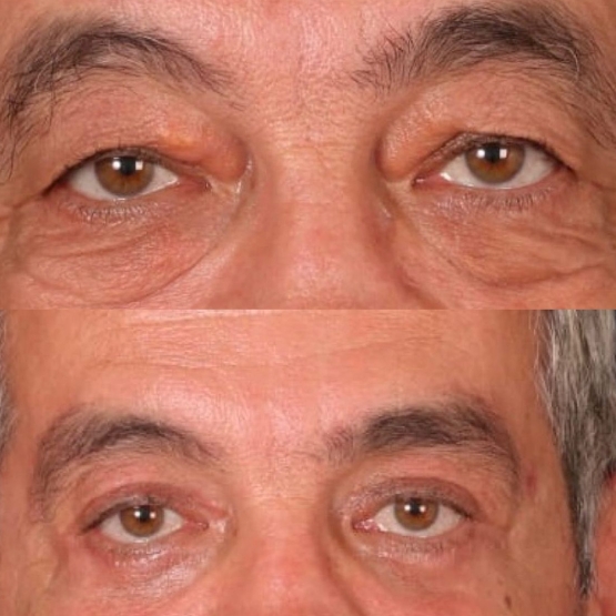 Eyelid Surgery in Turkey Before and After