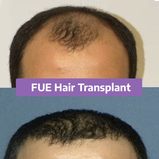 Hair Transplant Turkey Before and After