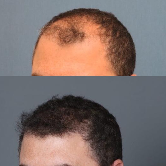 Hair Transplant Turkey Before and After