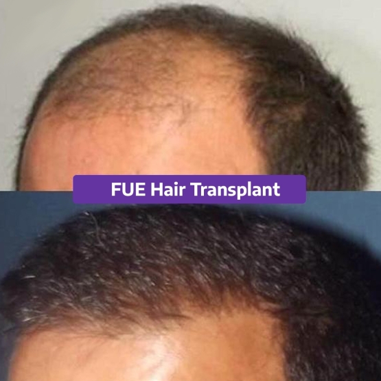 Hair Transplant Turkey Before and After
