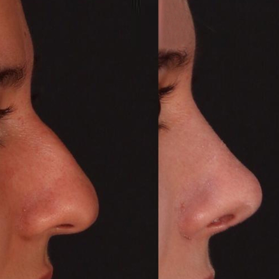 Rhinoplasty Before and After