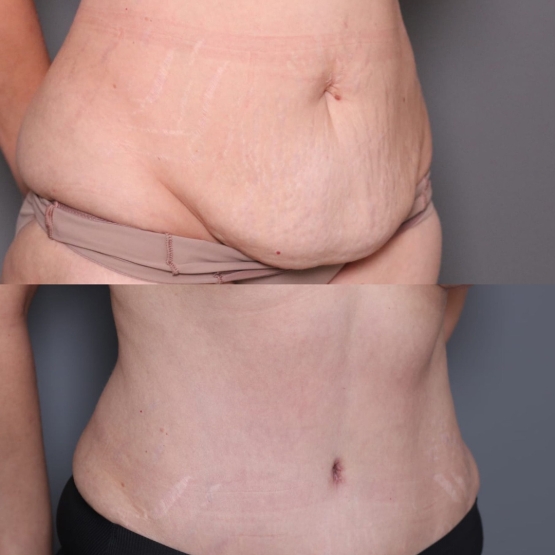 Tummy Tuck in Turkey Before and After