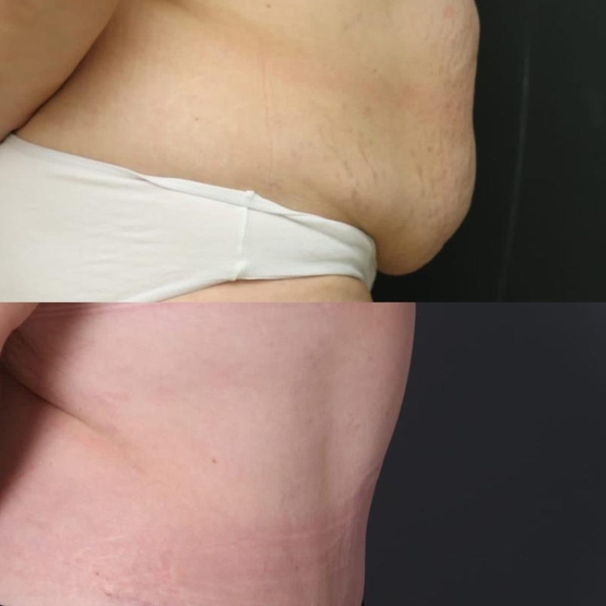 Tummy Tuck in Turkey Before and After