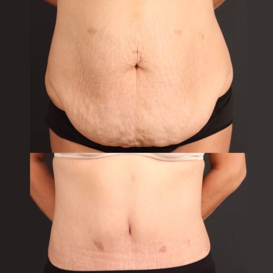 Tummy Tuck in Turkey Before and After
