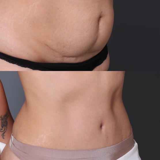 Tummy Tuck in Turkey Before and After