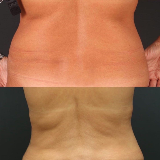 VASER Lipolysis Turkey Before and After