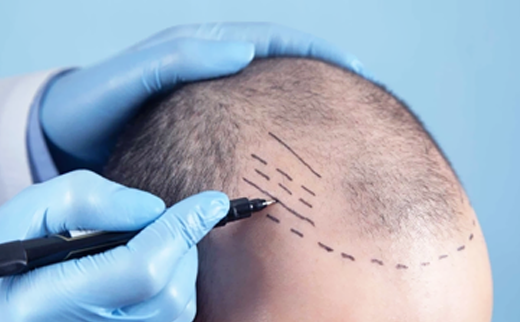 How Long Does A Hair Transplant Take?