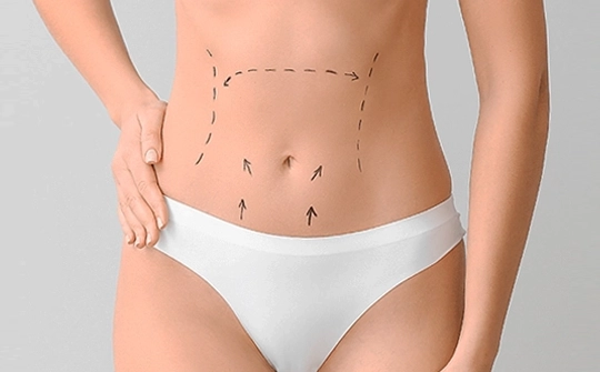 Abdominoplasty Surgery Antalya, Turkey