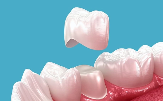 Dental Crowns Ankara, Turkey