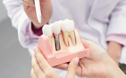 Dental Implant Treatment Turkey