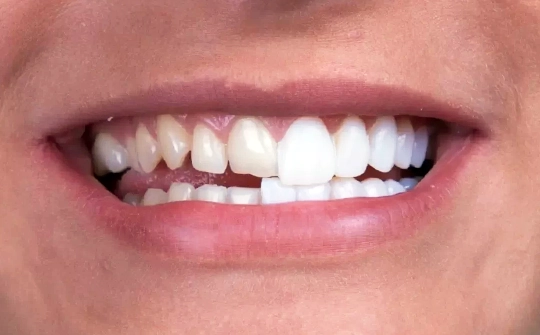 Dental Veneers Ankara, Turkey