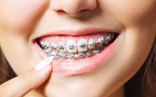 Orthodontic Treatment Turkey
