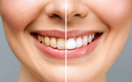 Teeth Whitening Ankara, Turkey