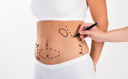 Tummy Tuck in Ankara, Turkey