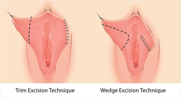 Labiaplasty in Turkey