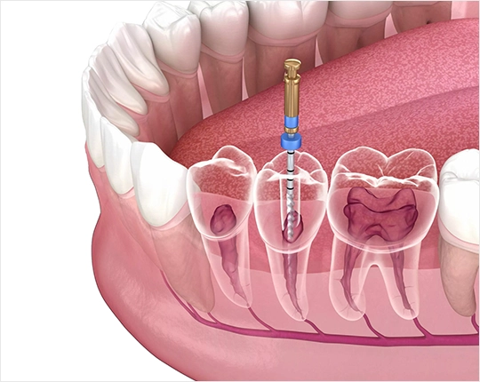 Root Canal Treatment Ankara, Turkey